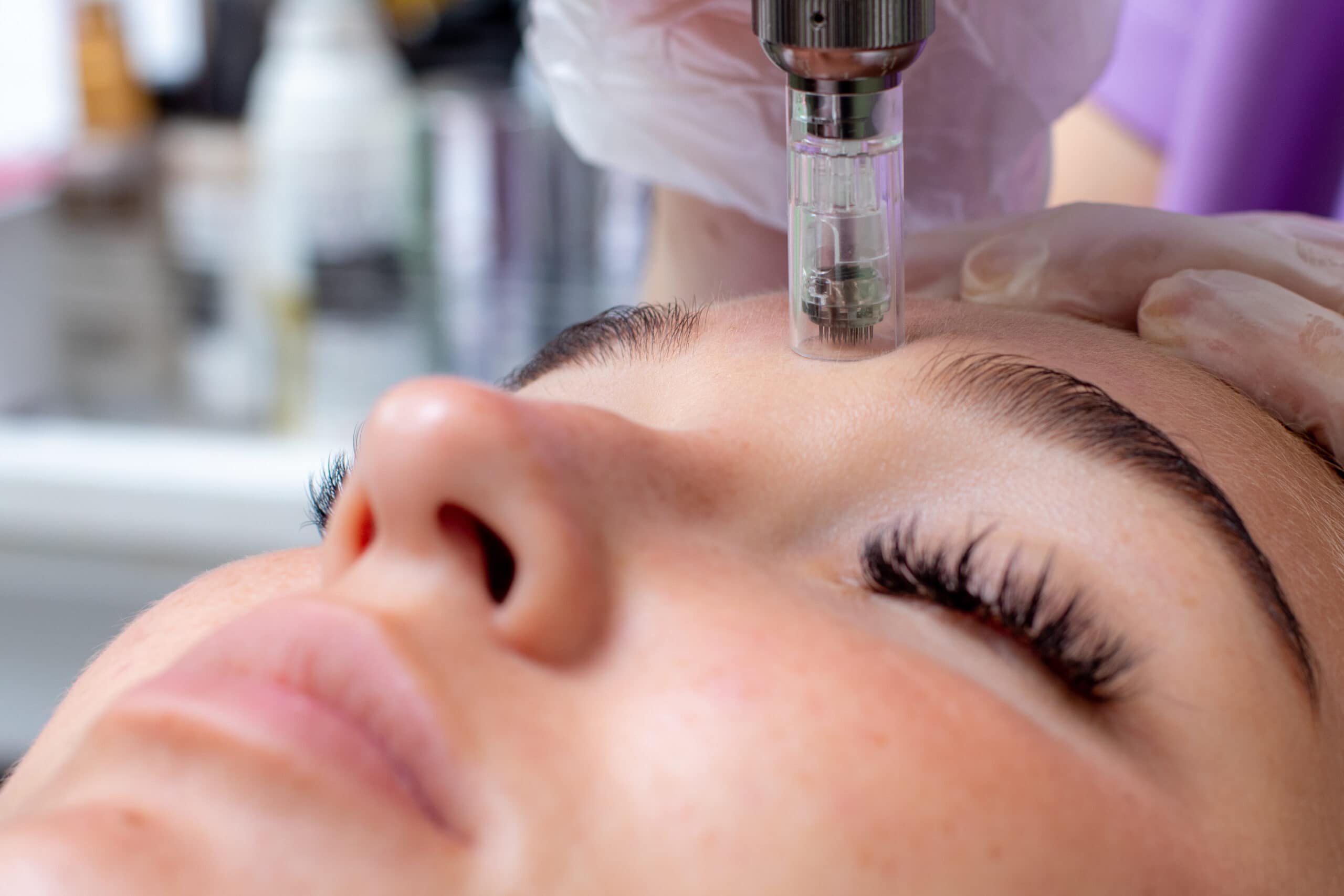 Closeup of a woman getting microneedling done on her face by a beauty technician in Jacksonville, FL.