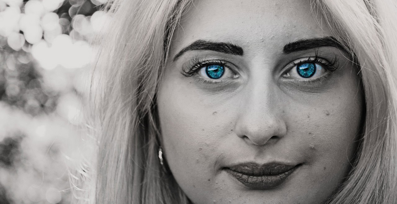 Close-up of a young woman with acne and striking blue eyes, emphasizing skin texture and complexion concerns.