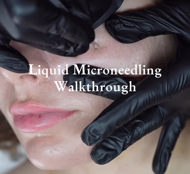 Woman getting liquid microneedling done by an esthetician at Kristina Marie Beauty.